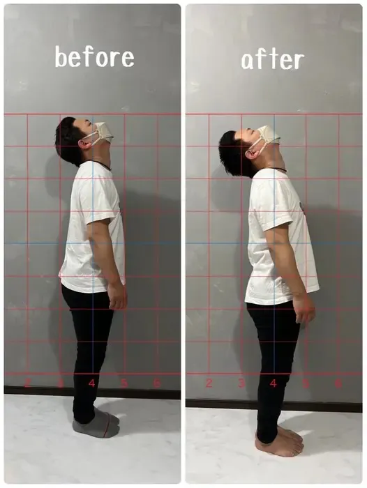 数年前に軽度の頚椎損傷されたお客様😭