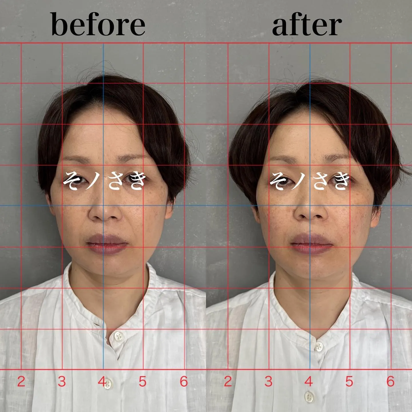 🔥ほうれい線撃退🔥